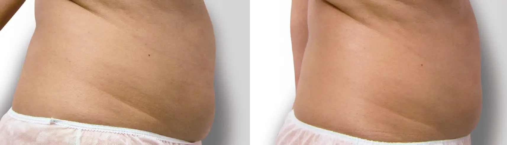 indiba-corporal-antes-despues-reafirmacion-abdomen-lateral