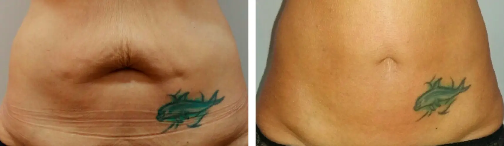 indiba-corporal-antes-despues-reafirmacion-abdomen-tatuaje