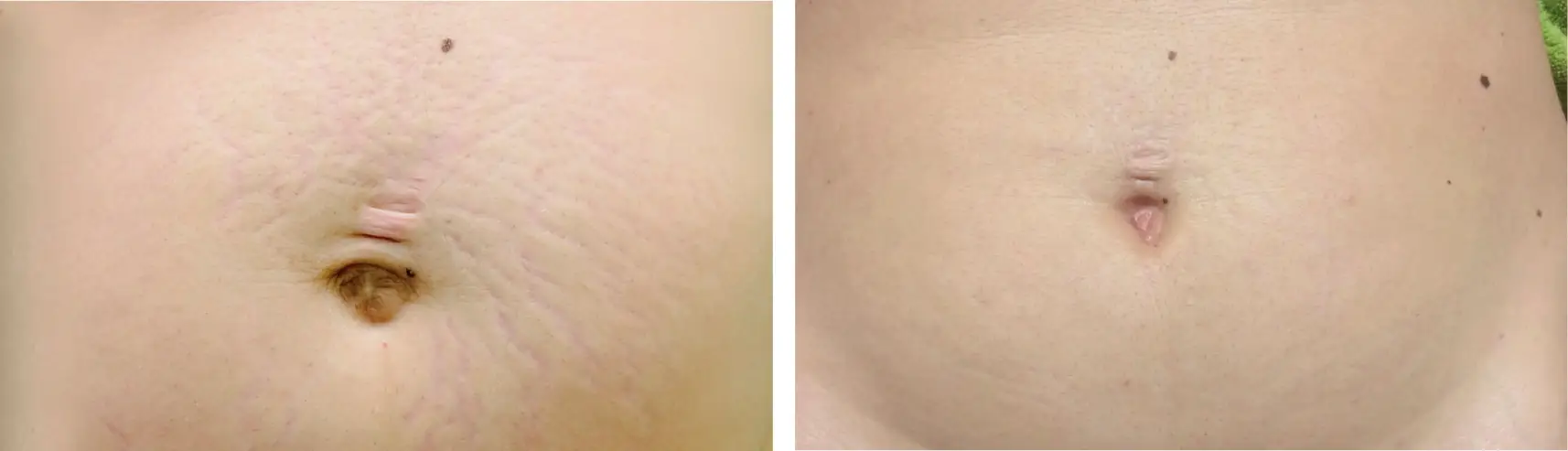 indiba-corporal-antes-despues-tratamiento-abdominal